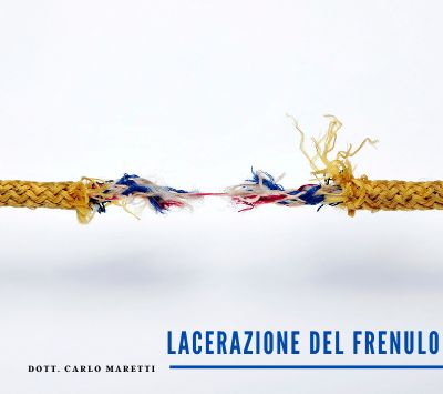 lacerazione frenulo