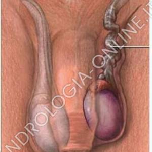 La torsione testicolare si verifica soprattutto nei maschi giovani, sotto i 25-30 anni, ma può manifestarsi a ogni età. Alcuni uomini sono più predisposti per motivi congeniti, ma la causa della torsione può essere anche un
