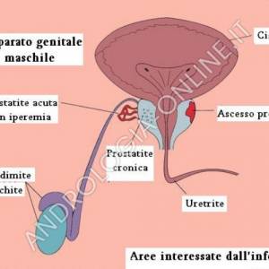 Per prostatite ssi intende qualsiasi forma di infiammazione ella ghiandola prostatica.