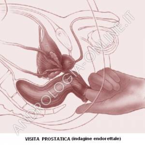 Data la sua posizione, la prostata può essere esaminata dallo specialista inserendo un dito nel retto. Si riesce così a palpare la porzione posteriore delle ghiandola, riuscendo ad apprezzarne la consistenza.