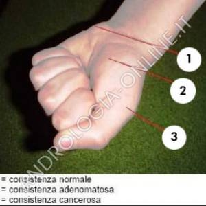 Il riferimento mentale più utile è quello indicato nella figura: la mano stretta a pugno dimostra che la consistenza dell’eminenza ipotenar (1) è quella normale; l’eminenza tenar (2) ricorda l’adenoma e la prima articolazione metacarpo-falangea (3) è simi