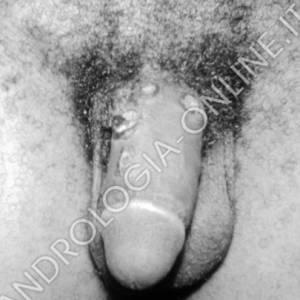 Pene con sifilide primaria
