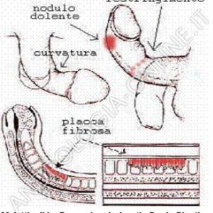 La fase iniziale della manifestazione clinica è caratterizzata molto spesso da dolore del pene in erezione, parestesie locali e comparsa di noduli o placche di indurimento nella tonaca albuginea con aree di restringimento del pene. Nelle fasi più avanzate