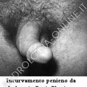 Incurvamento penieno da Induratio Penis Plastica