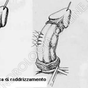 Intervento chirurgico con una corporoplastica secondo Nesbit. L