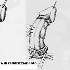Intervento chirurgico con una corporoplastica secondo Nesbit.